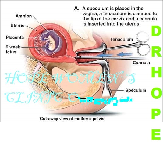abortion pills for sale in Warmbaths +27717209144 Cytotec In Letaba,Messina,Warmbaths